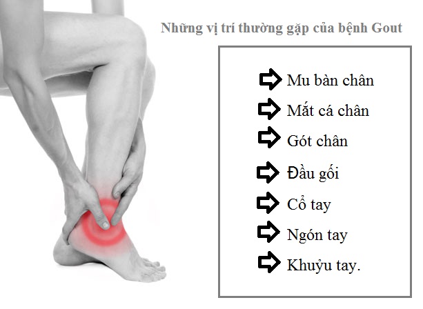 Gout và những câu hỏi thường gặp — Siêu Thị Sức Khỏe