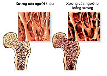 Hình ảnh so sánh xương người khỏe và người bị loãng xương