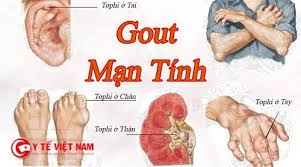 Gout mạn tính